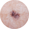 Skin cancer details