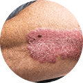 Psoriasis details