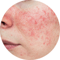 Rosacea details