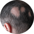 Alopecia details
