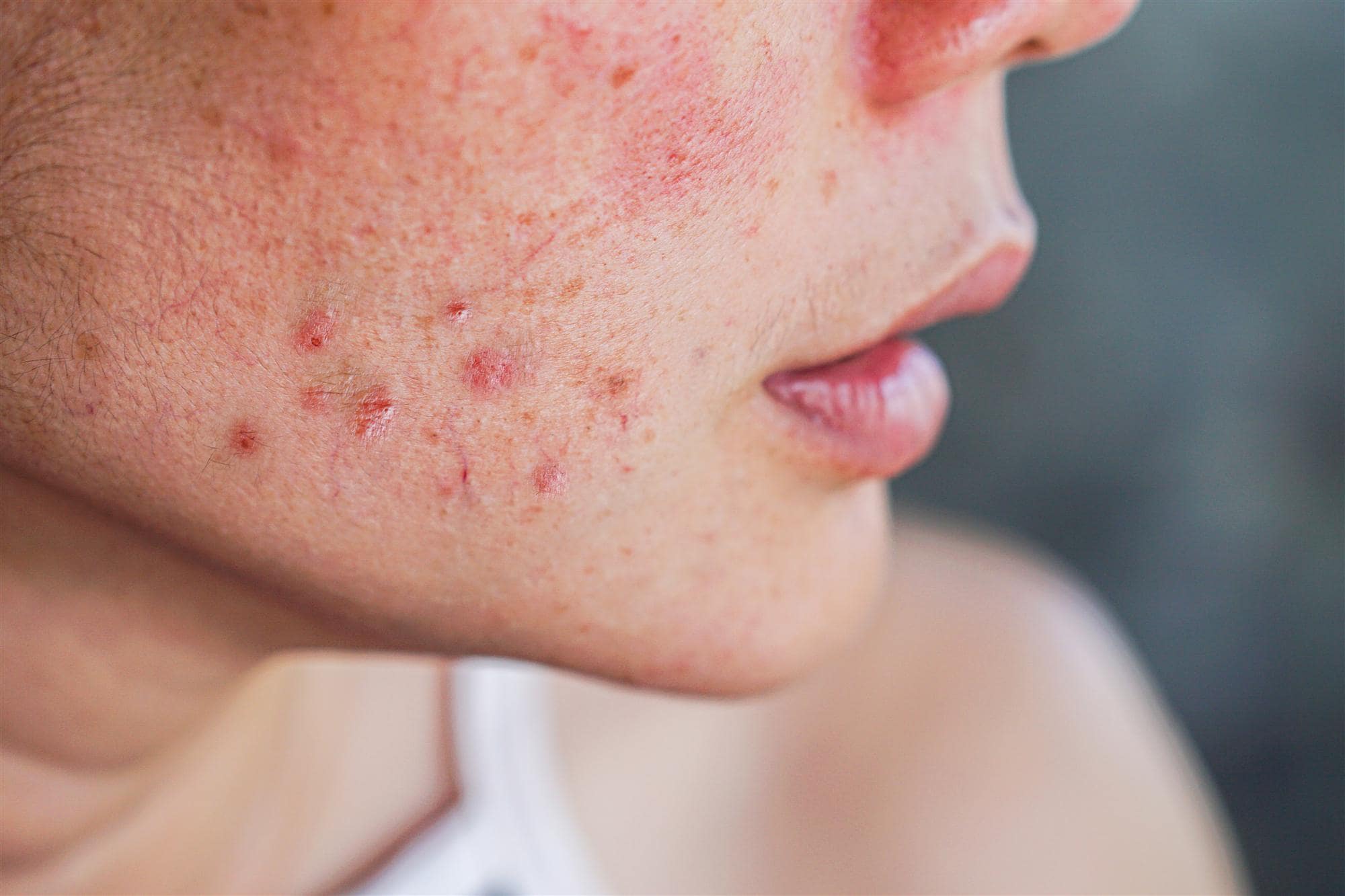 deep acne scars