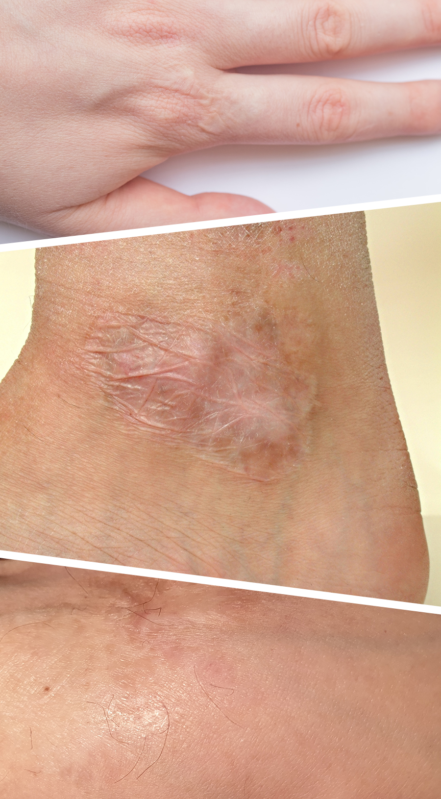 how laser therapy for burn scars works