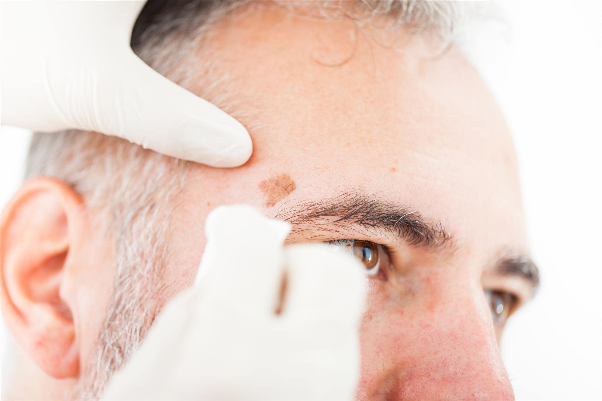 Mohs surgery for the face from DCP Mohs surgery for the face