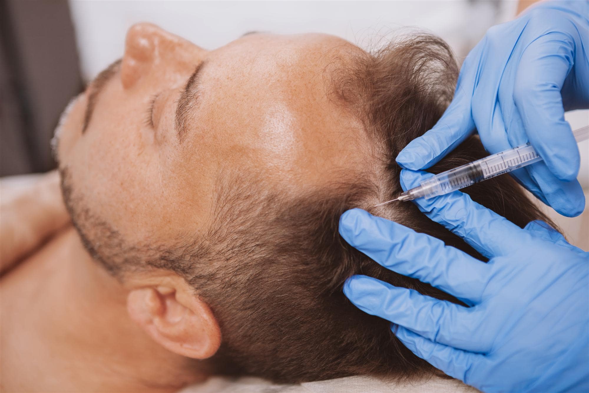 PRP injections for receding hairline