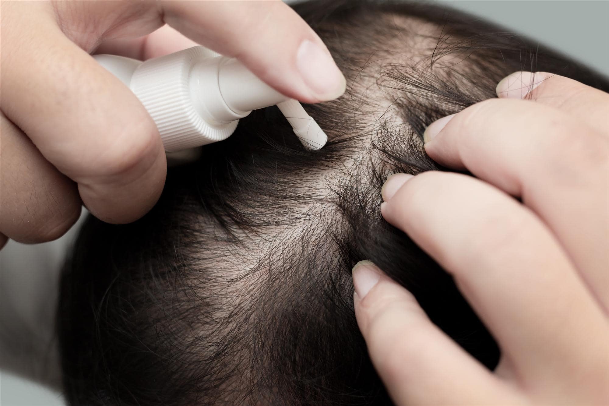 topical creams for hair loss