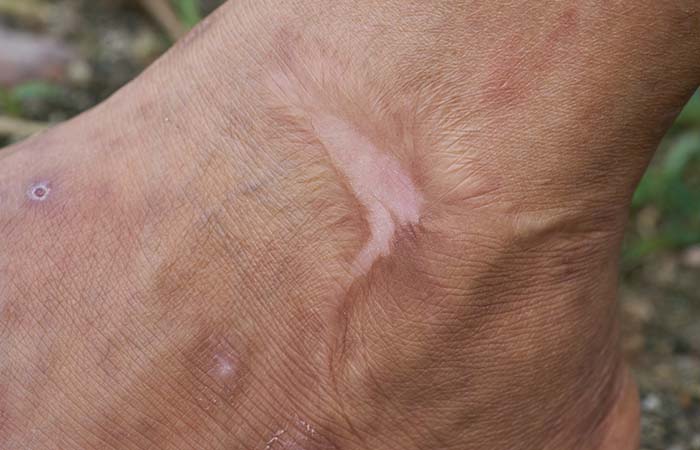 Dr. Steffes offers the best treatments for burn scars Laser Therapy for Burn Scars
