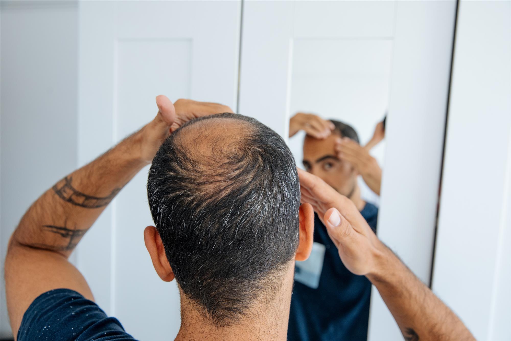Hair loss treatments for Men in Wisconsin at DCP Men's Hair Loss treatments at DCP